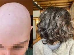Regione  ER – Contributi per l’acquisto di parrucche destinate ai pazienti con alopecia areata